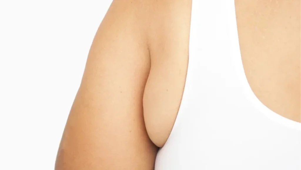 Woman in white tank top showing visible underarm bulge, highlighting target zone for armpit fat removal treatment.