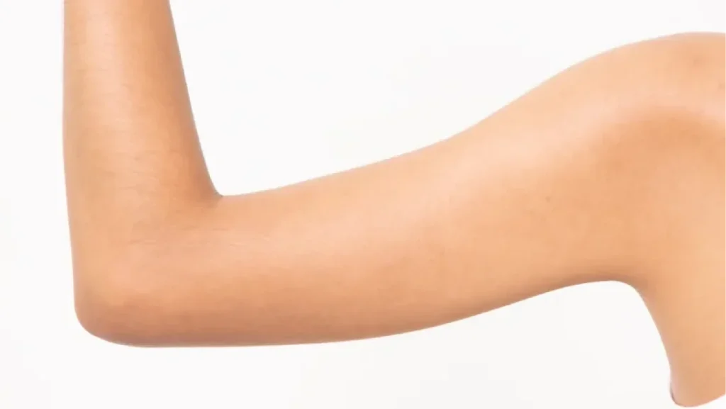 Toned female arm after armpit fat removal, showing smooth contour and improved definition in upper arm area.