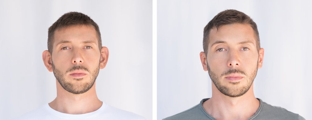 otoplasty before and after