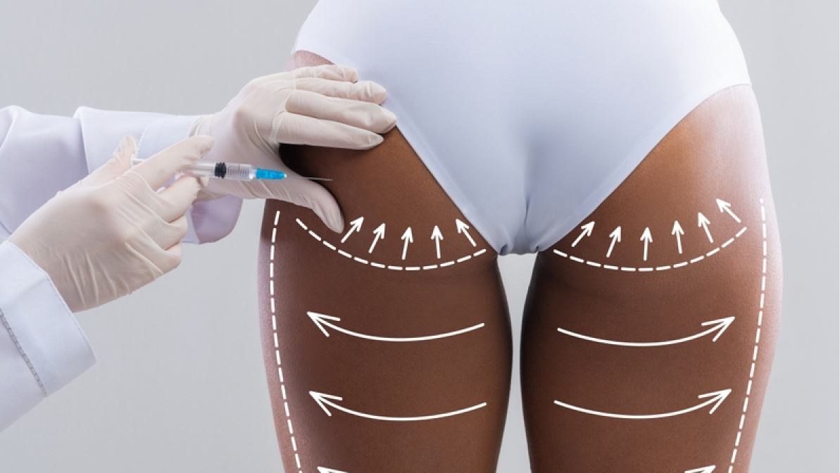 Medical professional performing injection procedure with contour lines to adjust results during bbl reversal.