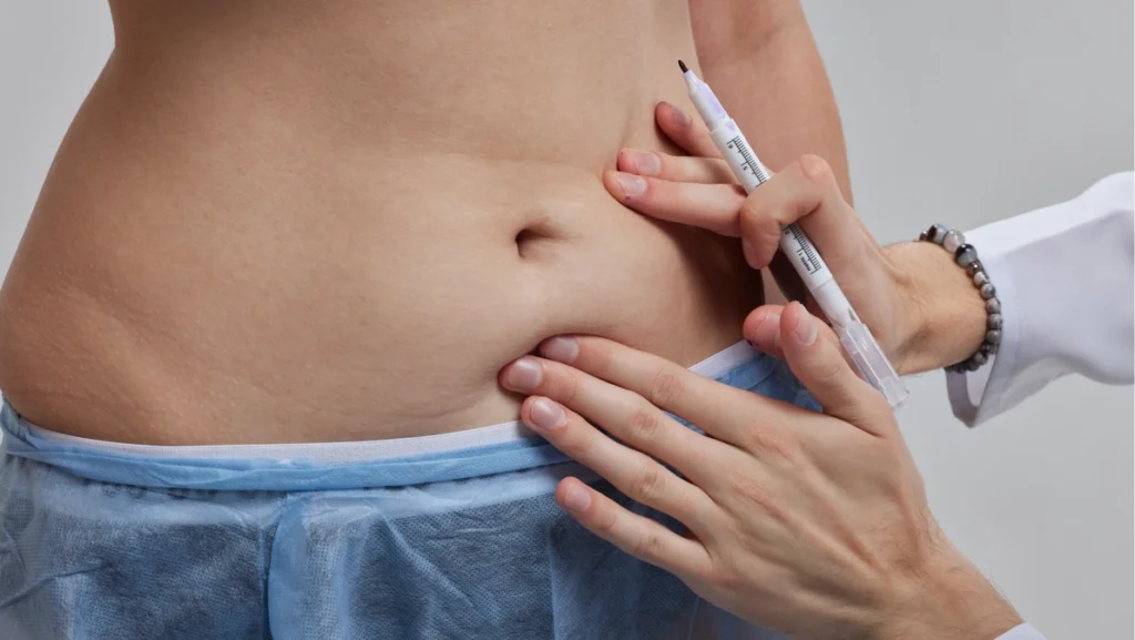 Surgeon marking abdominal area before procedure, explaining expected tummy tuck recovery time and healing process.