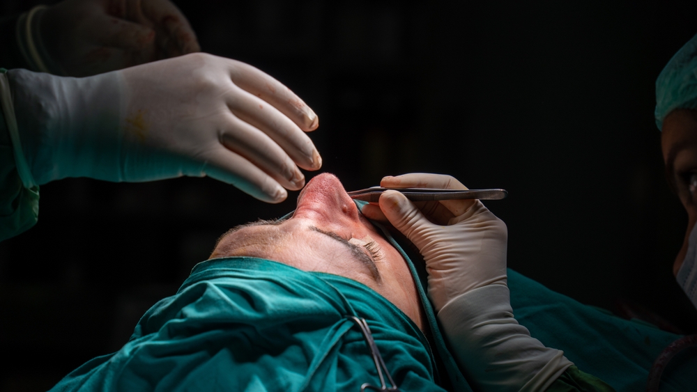 rhinoplasty surgery, defects in the shape of the nose in the female patient.