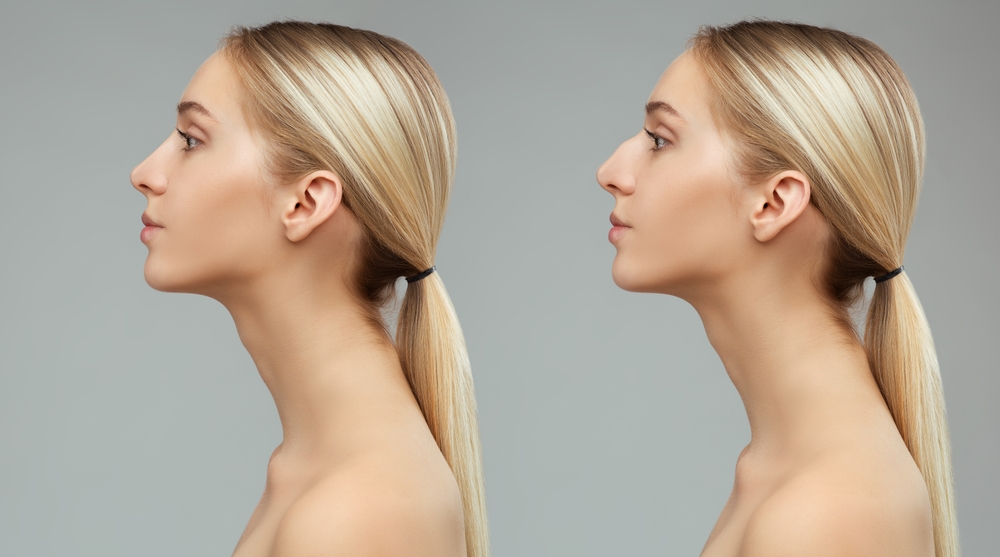 Woman Nose Job Before and After.