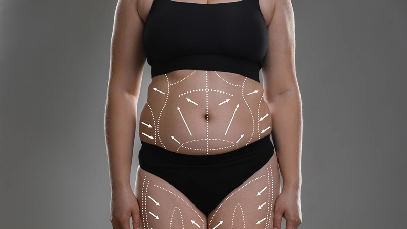 Plastic surgery. Woman with excessive fat on grey background, closeup. Figure correction arrows and lines on skin