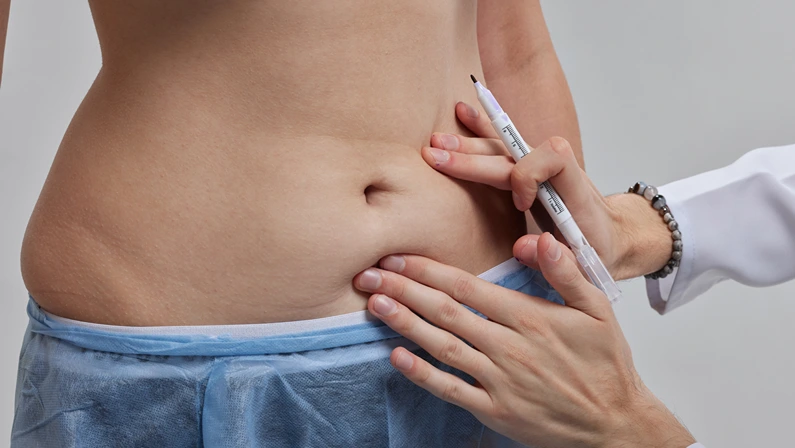 the doctor makes markings with a marker before the tummy tuck operation, Abdominoplasty