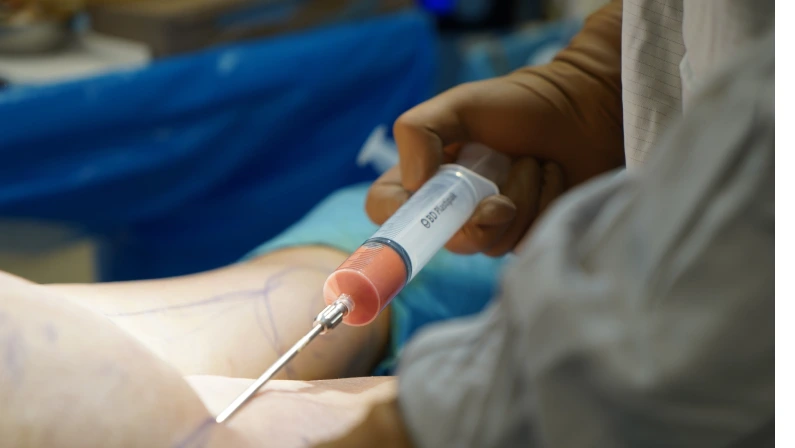 fat injection surgery, plastic surgery