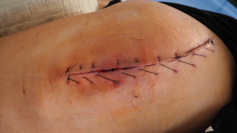 sutures wound Close up
