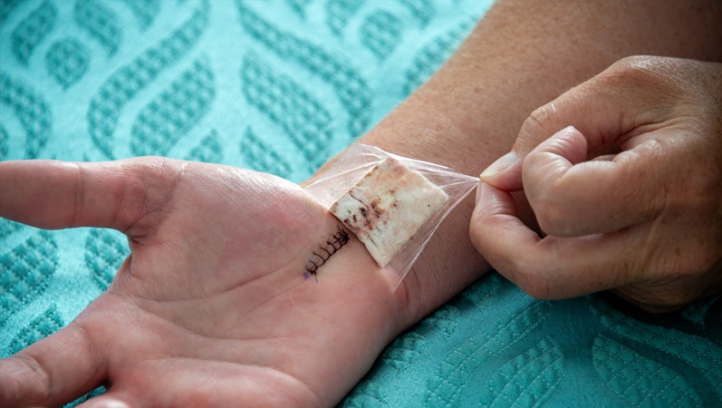 A female nurse removes a padded bandage on the wrist and hand of a woman. The palm has a number of black nylon stitches from a recent carpal tunnel surgery. The wound is closed with no infection.